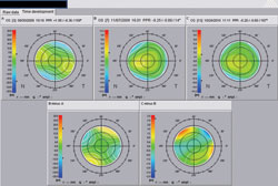 Figure 3b. The difference map between preop, 1-month and 1-year follow-ups showed fairly stable, predicted phoropter refraction and 2-D plots between the two postoperative follow-ups.