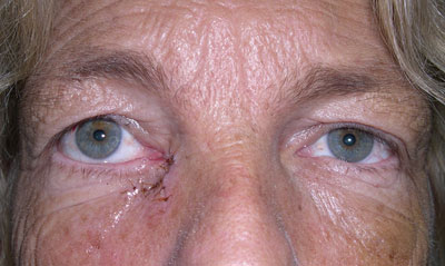 Figure 5. An example of a completed lower lid laceration repair. 