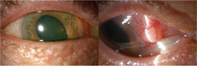 Figure 1.  Anterior segment photos of the right eye are notable for a flesh-colored iris lesion and a nodular conjunctival lesion. 