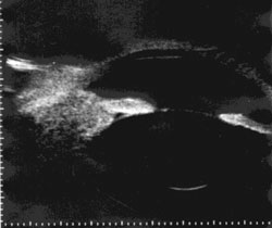 Figure 2. Ultrasound biomicroscopy demonstrates a hyperreflective ciliary body mass, with extension into the iris and conjunctiva.  