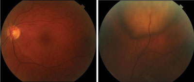 Figure 3.   Fundus photos of the left eye demonstrates a 5-mm, cream-white colored choroidal mass in the superior midperiphery. 