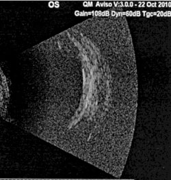 Figure 4. Ultrasound demonstrates an elevated choroidal lesion with low internal reflectivity.