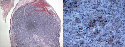 Figure 5.  Biopsy of the bulbar conjunctiva and limbus was stained with H&E and estrogen receptor immunohistochemical stains, respectively, and demonstrated adenocarcinoma consistent with metastatic breast cancer. Tissue was also estrogen receptor positive, but progesterone receptor and HER2/neu receptor were negative.