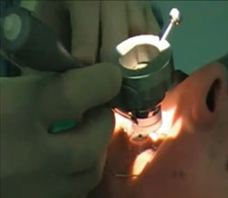 Figure 1. Targeting stage is placed on the eye, and suction is applied.