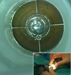 Figure 3. Applicator ring is centered over corneal apex mark using X-Y translation dials.