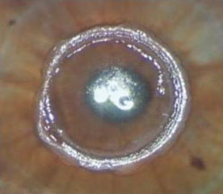 Figure 5. Annular epithelial defect immediately after procedure.