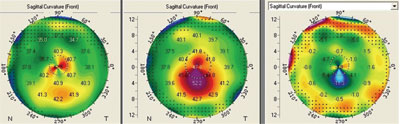 Figure 7.  Representative preoperative and 3 month postoperative topography with difference map.