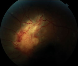 Figure 1.  Fundus photograph of the left eye, notable for a granulomatous mass involving the optic nerve head, with tortuosity of adjacent retinal vessels.