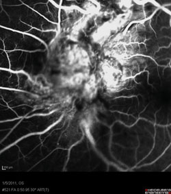 Figure 2a. Fluorescein angiography image taken at 50 seconds, demonstrating a vascularized lesion with late leakage.