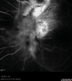 Figure 2b. Fluorescein angiography image taken at 4:22 minutes, demonstrating a vascularized lesion with late leakage.