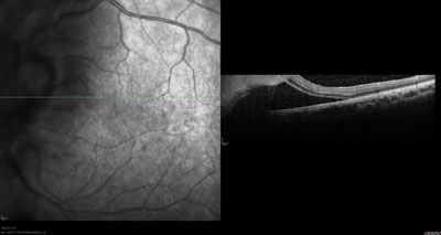 Figure 3.  OCT image demonstrates significant subretinal fluid extending into macula.