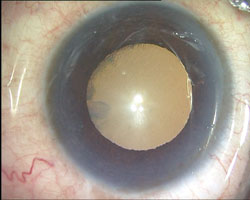 A conventional foldable IOL in the bag after performing cataract surgery.