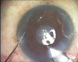 A conventional foldable IOL in the bag after performing cataract surgery.