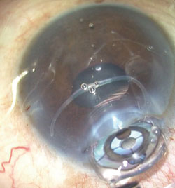 The LMI-SI has been coated with viscoelastic and inserted through the  clear corneal incision