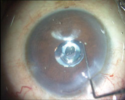 Photograph showing the LMI-SI well-centered with a clear cornea.