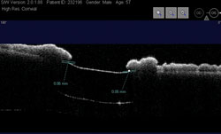 Anterior segment OCT showing the LMI-SI in the sulcus above the bag-implanted IOL.