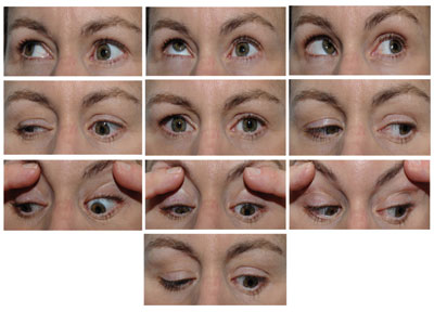 Figure 1. Motility photos demonstrating limitation of elevation, adduction and depression of the left eye. 