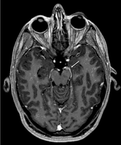 Figure 2. T2 weighted MRI with gadolinium showing a 5 mm x 5 mm x 6 mm homogenously enhancing mass along the left CN 3 in the cistern.