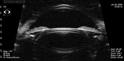 A sizing nomogram based on ultrasound biomicrocopy measurements of sulcus-to-sulcus distance