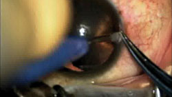 Figure 1. A mini crescent blade is used to tunnel back from the limbus in order to make a limbus-based scleral tunnel.