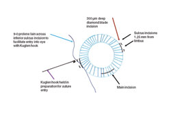 Figure 3. A schematic diagram of the eye depicts the relationship of the limbal wounds, the sulcus wounds, the main wound and the preparation of the Prolene for insertion into the eye.