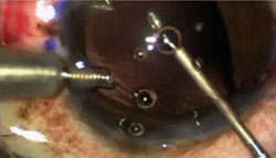 Figure 4. The Prolene suture is passed from its insertion of the Kuglen hook to micro-forceps and withdrawn out of the main wound.