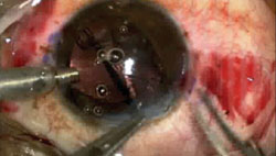 Figure 5. The lens will unfold spontaneously once inserted in the eye.