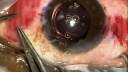 Figure 6a. Centration of the lens is monitored carefully during tying of the Prolene sutures. 