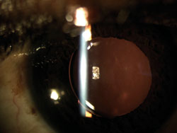 Figure 6b. Postoperative week 1 photo shows a well-centered IOL