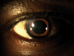 Figure 6c. A healthy, non-manipulated conjunctiva and quiet eye with a well-centered IOL.