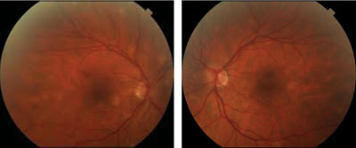 Figure 1. Both optic nerves appear healthy with no significant increase in cup-to-disc ratio. 