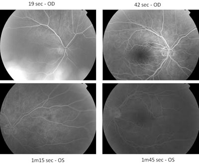 Figure 2. Fluorescein angiogram staining is most suggestive of multiple evanescent white dot syndrome.