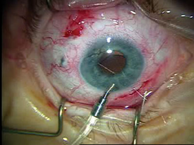 The other end of the SSL-15 mattress suture is passed lateral to the haptic to capture the polyimide prongs.