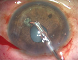 Figure 1. Intraocular foreign body in the anterior chamber.