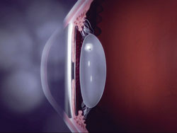 Figure 2. Intralenticular intraocular foreign body.