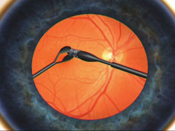 Figure 3. Handshake technique to remove an intraocular foreign body.