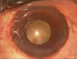 Figure 4. Siderosis.