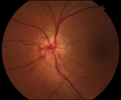 Figure 1. Optic disc photo of the left eye showing disc edema and peripapillary hemorrhages.