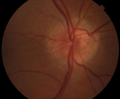 Figure 2. Optic disc photo of the right eye showing nasal pallor. 