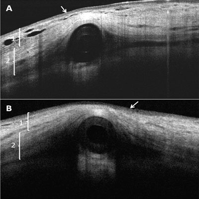 Figure 2. Anterior segment OCT images at 3 months (a) and 12 months (b) postoperatively.