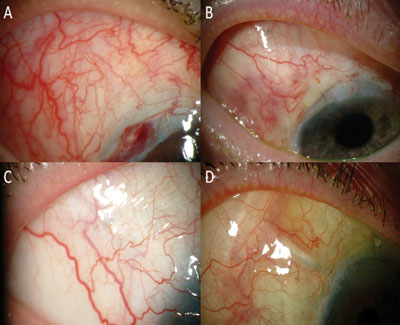 Figure 3. Postoperative photographs showing the superior temporal quadrant of the conjunctiva over the AM graft and tube shunt at 1 week (a), 1 month (b), 6 months (c) and 12 months (d).