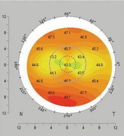 Figure 1a. Symmetric bowtie astigmatism.