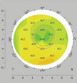 Figure 1b. Irregular crab-claw astigmatism.