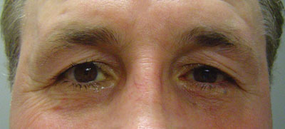 Figure 2. External photograph of both eyes, showing upper eyelid margin position.