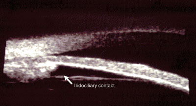 Figure 3. Ultrasound biomicroscopy of the right eye revealing iridociliary contact consistent with plateau iris syndrome.