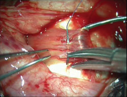 Figure 1. Medial recti secured.