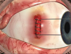 Figure 2. Medial recti cut and rotated to expose the optic nerve.