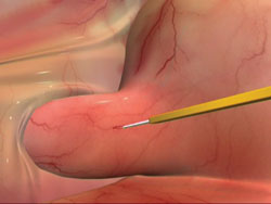 Figure 3. Cut made into the dura of the optic nerve until a gush of CSF occurs.