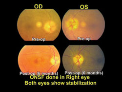 Figure 4. Fundus picture preop and postop of a case in which optic nerve sheath fenestration was performed.