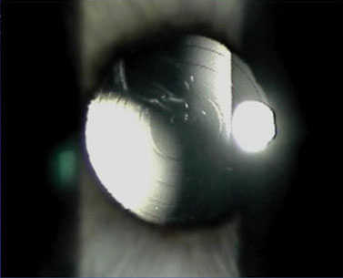 Figure 5. A centered multifocal IOL. Note diffraction rings are exactly concentric with the pupil.